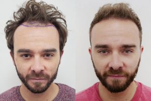 low cost hair transplant
