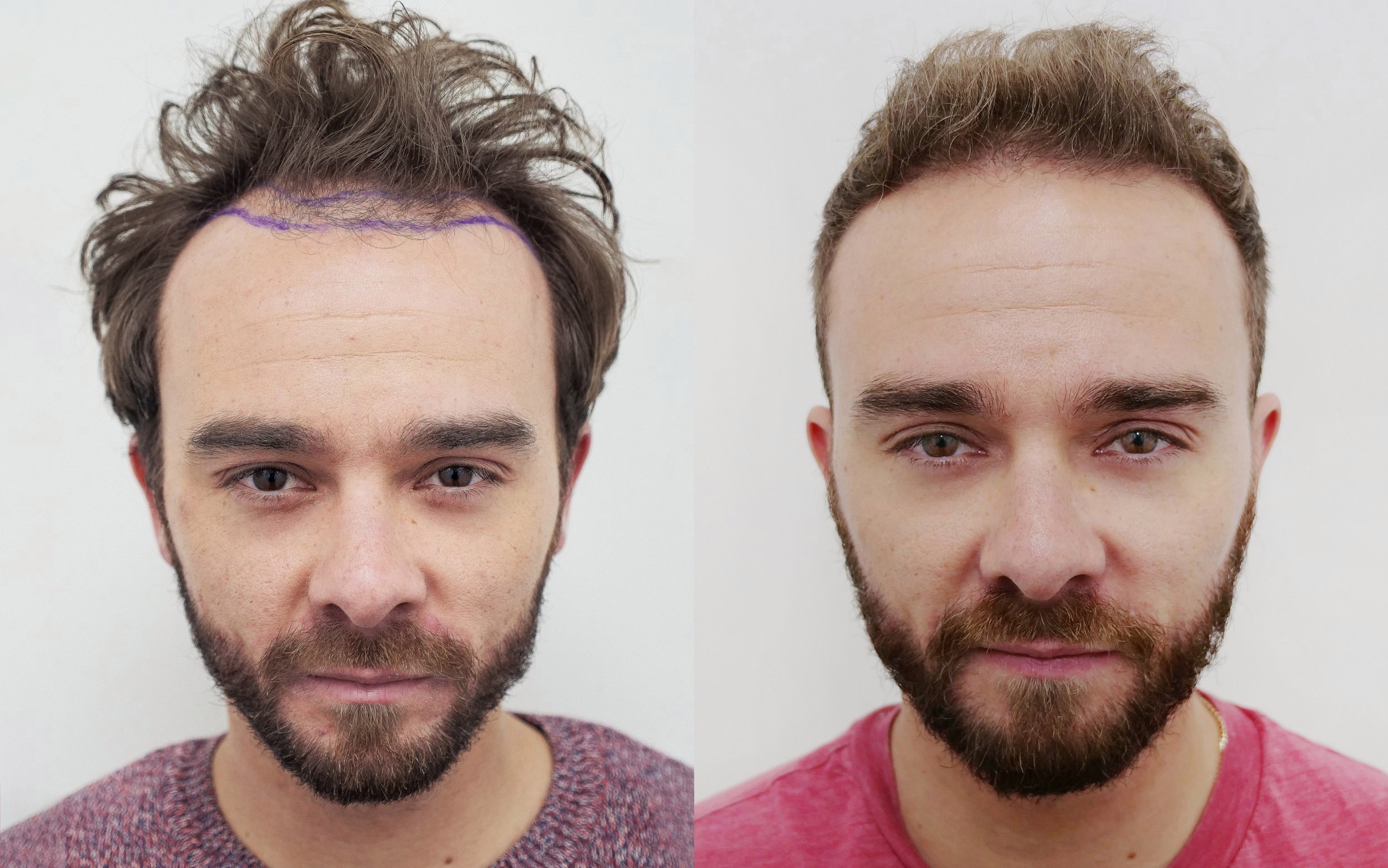 low cost hair transplant